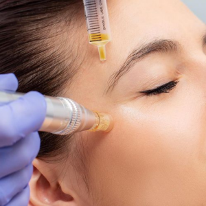 Microneedling with PRP treatment