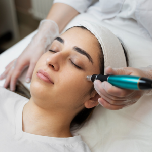 Microneedling PRP Treatment by woman
